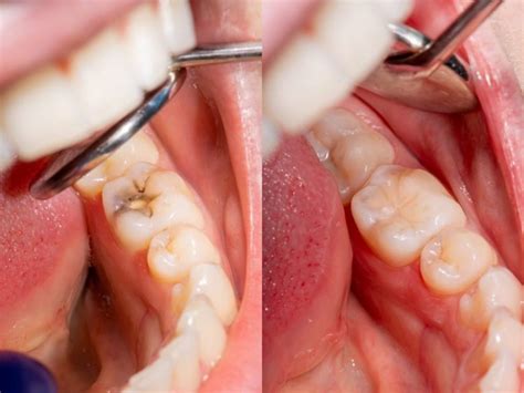 Is It Time To Replace Your Amalgam Fillings Excellence In Dentistry