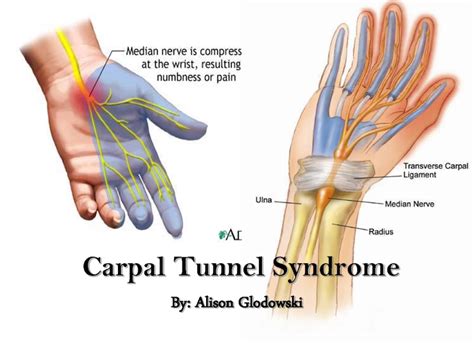 Bilateral Carpal Tunnel Syndrome Things Health