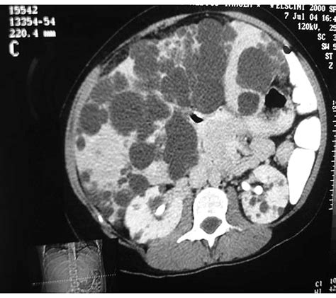 Polycystic liver disease (pld) is the result of embryonic ductal plate malformation of the intrahepatic biliary tree. Meningeal tumor: A rare extrahepatic association in ...