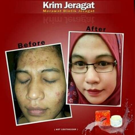 Namun, studi di journal of clinical and aesthetic dermatology melansir healthline, perawatan untuk mengatasi jerawat bisa menggunakan obat oles baik krim, gel, atau salep untuk membunuh bakteri. KRIM JERAGAT MOLEEK SKINCARE MURAH BORONG ORIGINAL ...