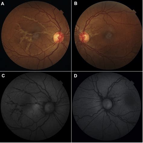 Angioid Streaks In Acquired Hemochromatosis Ophthalmology Retina