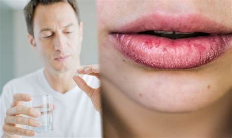 Chapped Lips Vitamin Deficiency Core Plastic Surgery