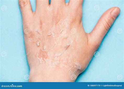 View Of Female Hand With Dry Stock Photo Image Of Dermatology
