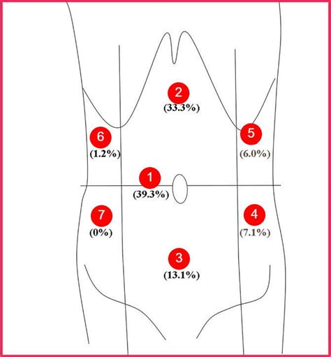 Typical And Atypical Ibs Pain Locations Diagram Included