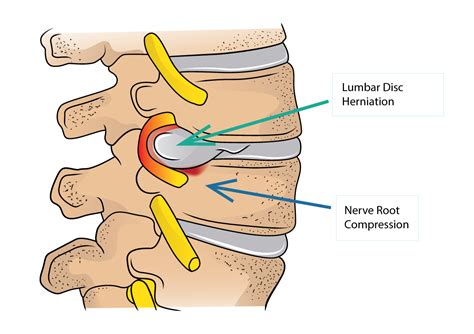 Lumbar Disc Herniation And Sciatica Dr Yu Chao Lee