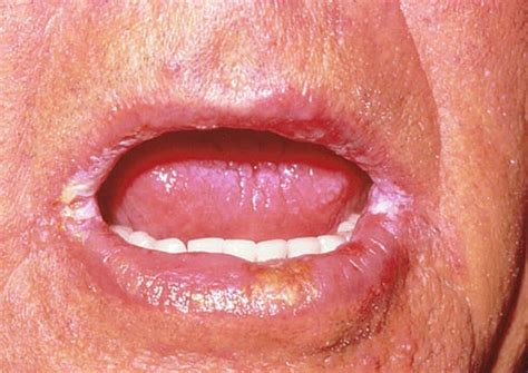 Angular Cheilitis Pictures Treatment Symptoms Causes Hubpages