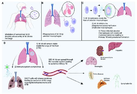 Overview Of The Manifestation And Pathophysiology In TB Infection As