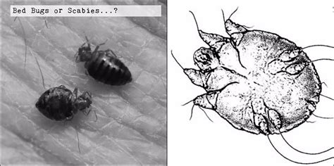 Bed Bugs V Scabies 5 Ways To Tell Scabies And Bed Bugs Apart