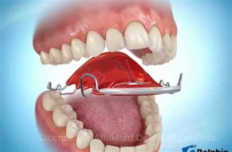 While this may cause teeth to move, it can also cause a number of complications like tooth fracture, gum damage, root damage, tooth loss, or serious medical complications. Hawley Spring Retainer - for minor teeth straightening | Beyond Dentistry | Pinterest | Braces ...