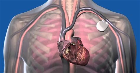 Implantable Cardioverter Defibrillator Used To Identify And Stop