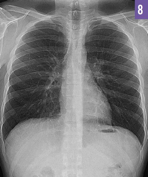 Spontaneous Pneumomediastinum Consultant360