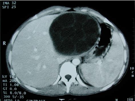 Hydatid Cyst Of The Left Liver With Typical Multivesicular Image