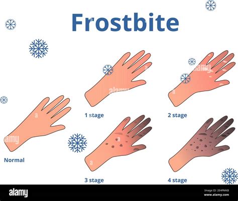 Frostbite Stages Vector Cartoon Illustration Of Hands Stock Vector