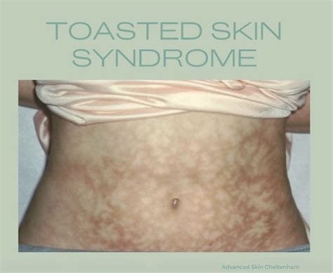 Toasted Skin Syndrome Advanced Skin Cheltenham
