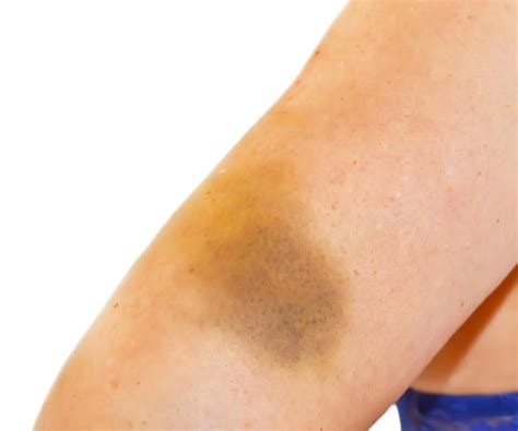 What Are The Best Treatments For Bruising And Swelling