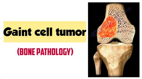 Gaint Cell Tumor Bone Tumor Bone Pathology Robbins Pathology Forward