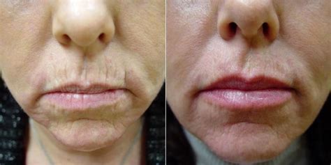 Radiesse And Restylane To Nasolabial Folds Marionettes And Lips
