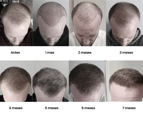 Details 71 Hair Transplant Month By Month Latest Ineteachers