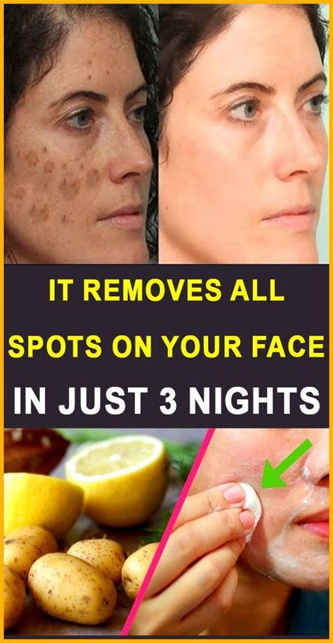How To Removes All Spots On Your Face In Just 3 Nights Wellness Daily