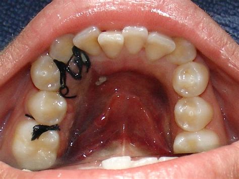 Odontología Peruana Hematoma Post Exodoncia
