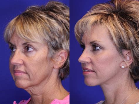 Cheek Implants Laser Skin Resurfacing Facial Plastic Surgery Brow