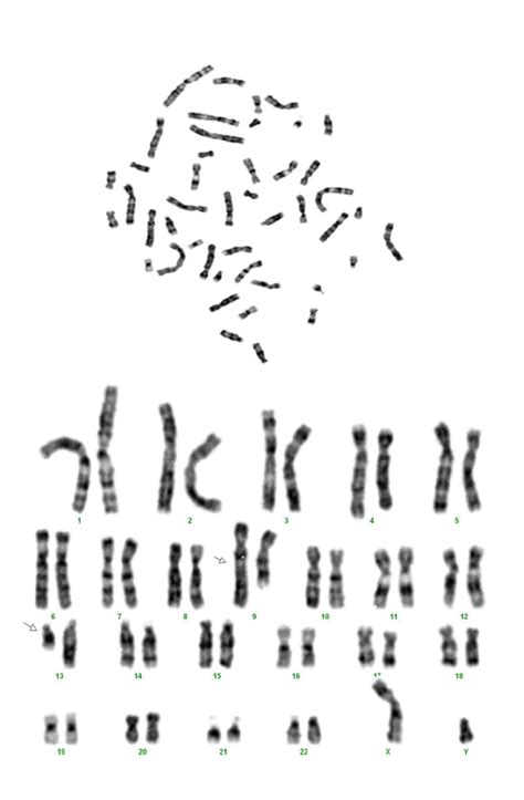Karyotyping In Patient No 59 Showing 46xyt913q34q14
