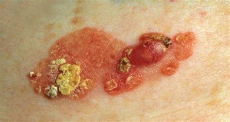 Basal cell carcinoma in chronic arsenicism occurring in queensland, australia, after ingestion of asthma medication. ¿Qué es Carcinoma? » Su Definición y Significado 2019