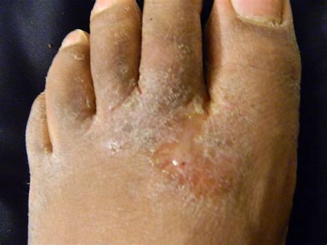 Athletes Foot Causes Signs Symptoms Treatment