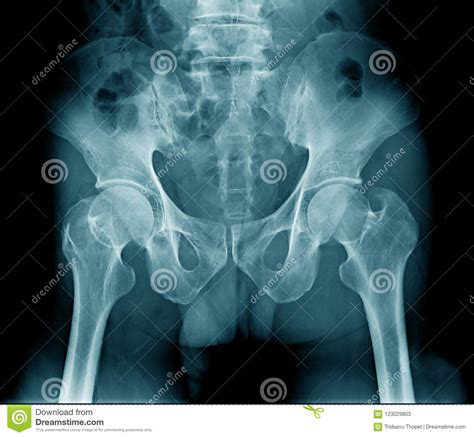 There are many organs that sit in the pelvis, including much of the urinary system, and lots of the male or female reproductive systems. X-ray pelvic bone stock image. Image of female, hips ...