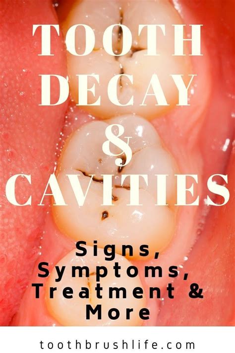 Guide To Cavities And Tooth Decay Everything You Need To Know How To