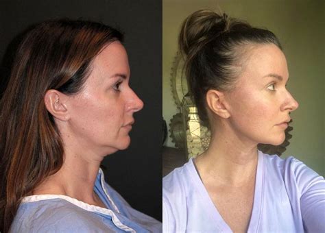 Deep Plane Facelift Before After Dr Andrew Jacono Face Lift