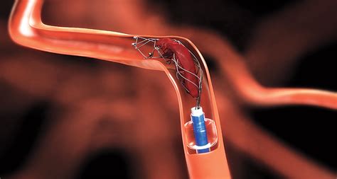 Detectability of cerebral hemisphere ischaemic infarcts by ct within 6 h of stroke. Snagging blood clots upgrades stroke care | Science News