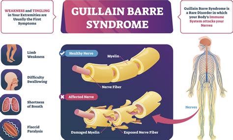 El síndrome de guillaín barré (sgb) es una polineuropatía desmielinizante . Síndrome de Guillain-Barré, raro trastorno neurológico ...