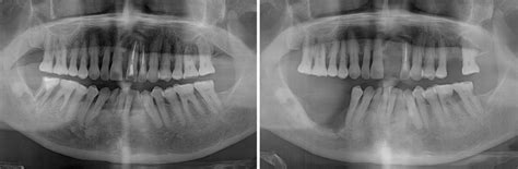 Osteonecrosis Jaw X Ray