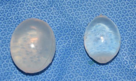 Plastic Surgery Case Study Long Term Silicone Testicular Implant