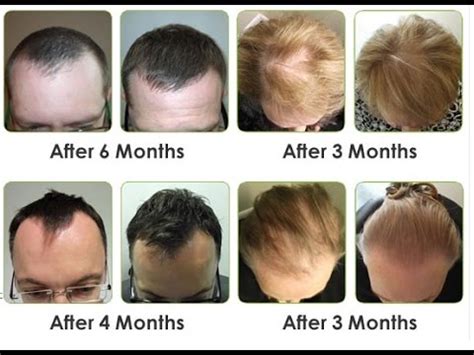 Lift hair in sections to spray directly onto scalp and. Bionnex Anti Hair Loss Serum Review