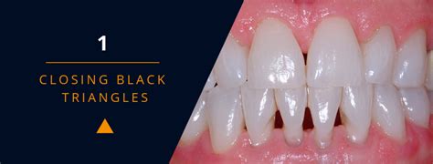 Closing The Gap In Direct Dentistry Treating Black Triangles Optident