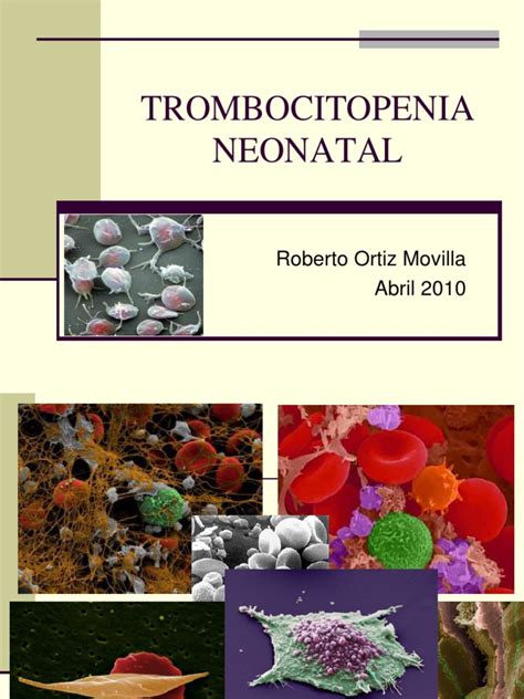 Thrombocytopenia is a condition characterized by abnormally low levels of platelets, also known as thrombocytes, in the blood. Trombocitopenia Neonatal | Sistema inmune | Plaqueta ...