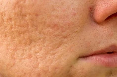 Cystic Acne Causes Symptoms And Treatments
