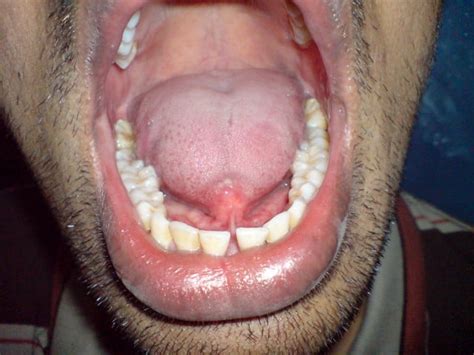 Midline Dermoid Cyst Of Tongue
