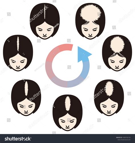 Female Pattern Hair Loss Set Stages Of Baldness Royalty Free Stock