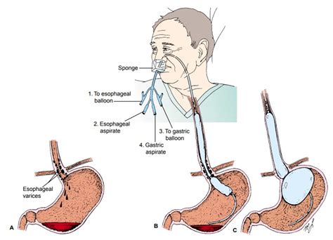 Esophageal Varices Banding