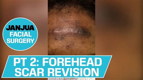 Forehead Scar Revision Part 2 Dr Tanveer Janjua New Jersey Youtube