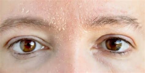 Eyebrow Dandruff Causes Treatment And Home Remedies Treat N Heal