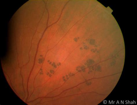 Congenital Hypertrophy Of The Retinal Pigment Epithelium Chrpe Mr