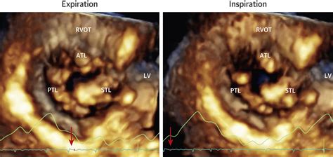 Morphological Assessment Of The Tricuspid Apparatus And Grading