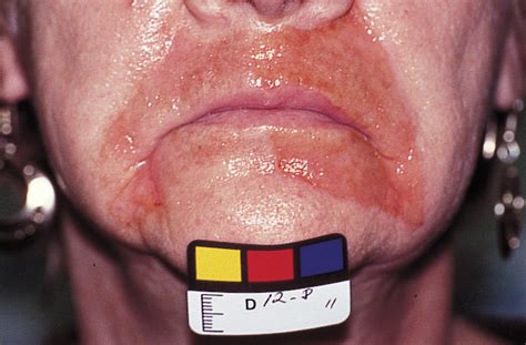 Black doll treatment manufacturers,a leading oem/odm supplier,manufacturer with own black doll treatment factory in wholesale business. Treatment of Perioral Rhytides: A Comparison of ...