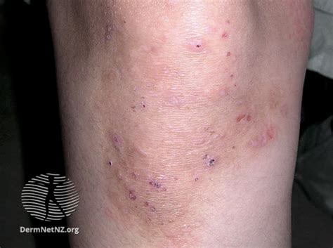 A Rash And An Upset Gut It Could Be Coeliac Disease — Dermatology Hawkes Bay
