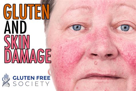 Dermatitis Herpetiformis Gluten Free Society