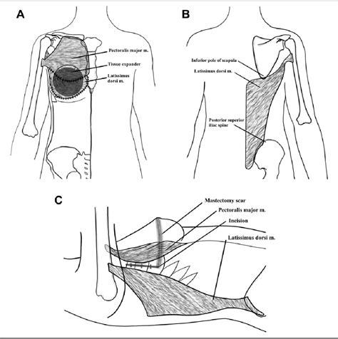 Figure 1 From Latissimus Dorsi Flap In Breast Reconstruction Semantic